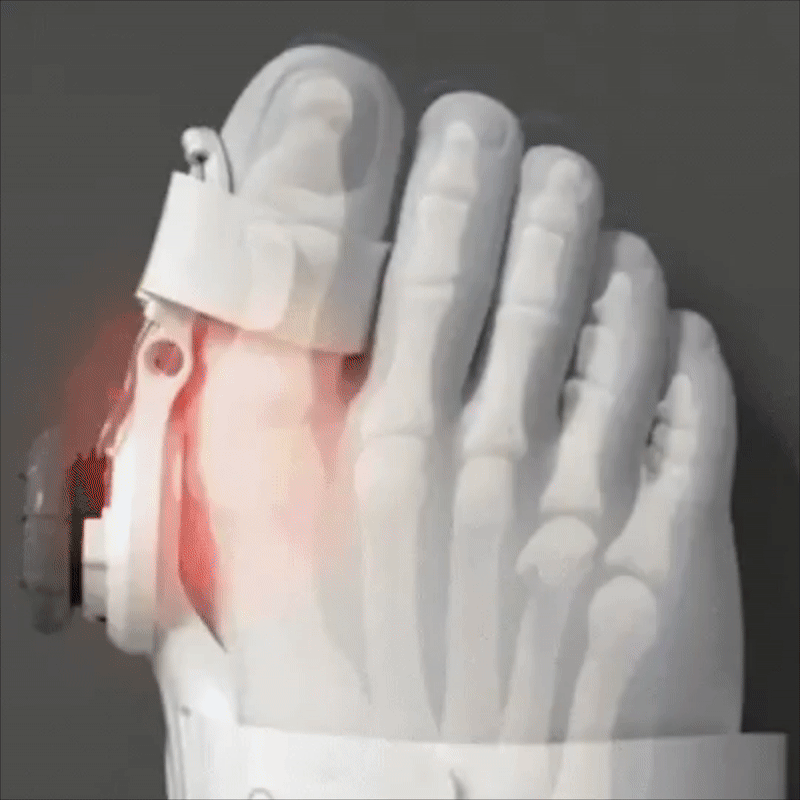 Je Bent Slechts Eén Stap Verwijderd van een Leven Zonder Hallux Valgus Pijn, Gezwollen Tenen of Voetklachten...